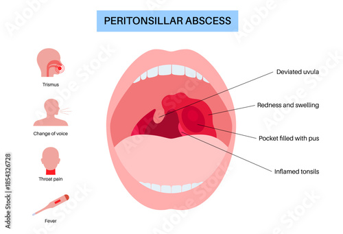 Peritonsillar abscess poster