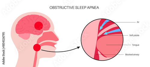 Obstructive sleep apnea