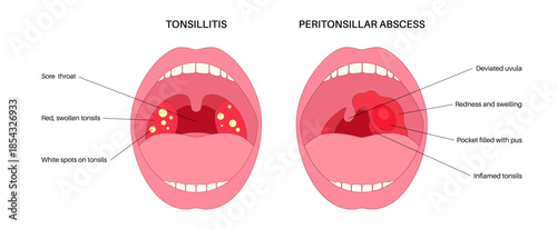 Peritonsillar abscess and tonsillitis