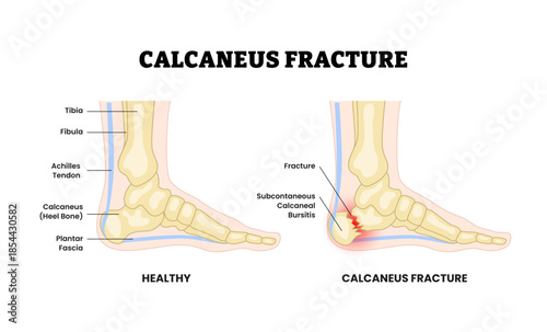 Calcaneus fracture as feet bone disorder condition. Broken heel bone structure. Broke leg skeletal. Medial view of left foot. Medical education poster flat vector illustration.