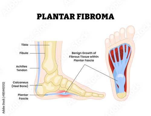 Plantar fibroma as feet bone disorder condition. Benign growth of fibrous tissue. . Plantar fascial fibromatosis. Ledderhoses disease. Medical education poster flat vector illustration.