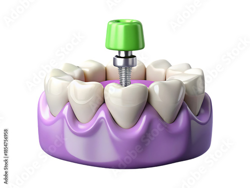 Dental implant in a model of teeth.  A dental implant,  green colored, is positioned in a  model of  teeth set within a  light purple gum-like base