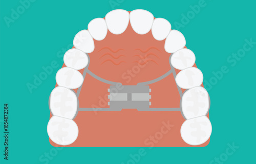 Orthodontic Palatal Expander and Human Teeth