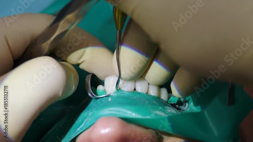 Dentist preparing oral cavity before installing veneers or dental crowns on sharpened teeth. closeup shot. Dental procedure video showing dentist expertly placing veneers. crowns on patient front