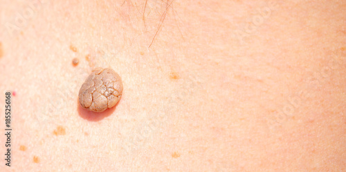 Nevus close-up. Mole on human skin. Irregular birthmark.