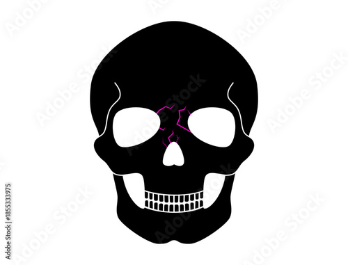 Nasal fracture poster