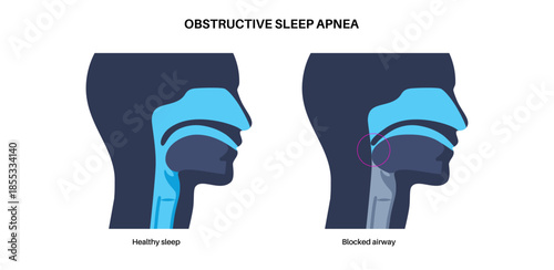 Obstructive sleep apnea