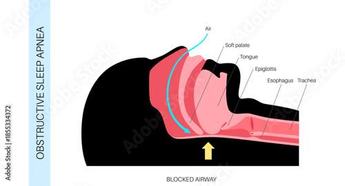 Obstructive sleep apnea