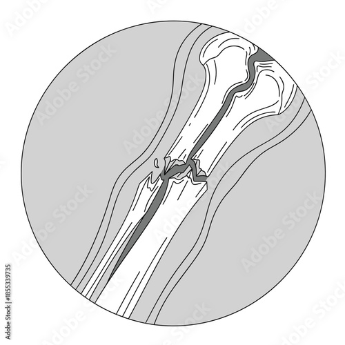 X-ray image of fractured bone in detailed medical illustration  