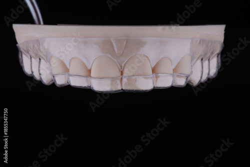 3D printed transparent dental template for gum correction fixed on model on black background.