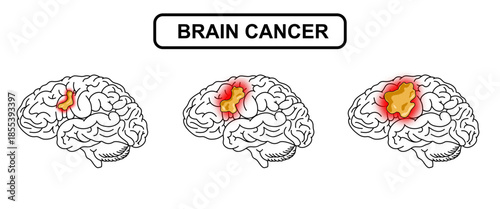 Brain tumor illustration. Human brain cancer, glioma, tumor in human brain tissue. Cancer cell structure. Vector illustration for medical, scientific, and educational purposes.