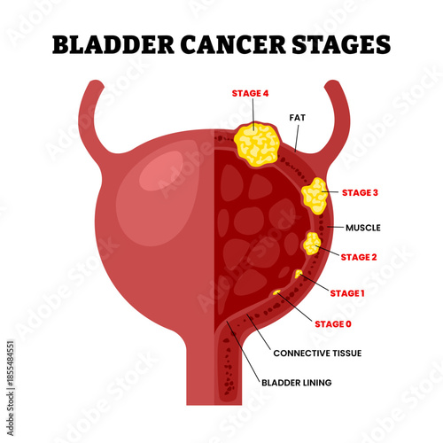 Stages of bladder cancer stages with anatomical oncology. Labeled connective tissue, fat, bladder lining. Illness growth and medical condition development vector scheme. Pathology diagnosis.