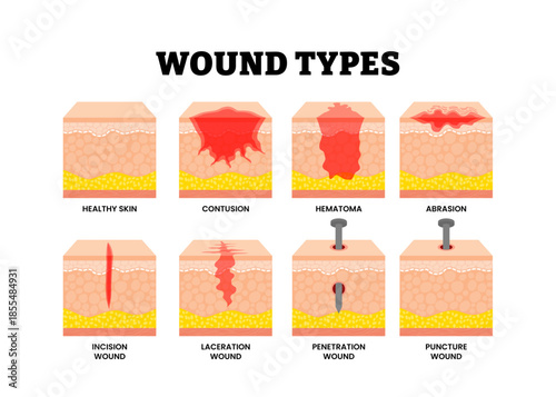 Different types of wound types showing skin injury. Labeled healthy skin structure, contusion, hematoma, abrasion, incision, laceration, penetration, puncture wound.