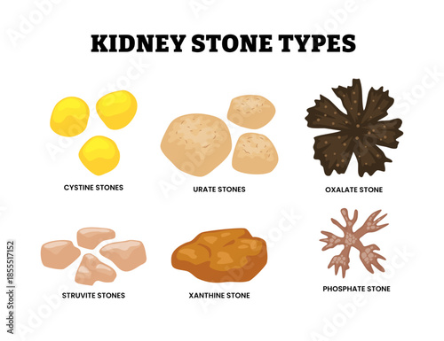 Different types of kidney stone types set collection. Labeled cystine, urate, oxalate, struvite, xanthine and phosphate stone. Deposits made of minerals and salts . Flat vector illustration.