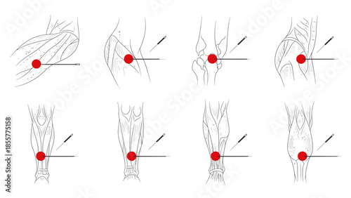 Diagrams illustrating various acupuncture points on different human body parts with needles for therapeutic purposes.