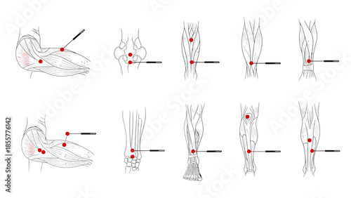 Anatomical diagrams illustrating various injection or acupuncture points on human limbs including arms, elbows, legs, and ankles.