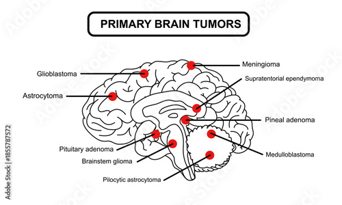 Primary brain tumors illustration. Glioblastoma, meningioma, pituitary and pineal adenoma. Cancer in cerebellum medulloblastoma and pilocytic astrocytoma. Vector illustration for medical and edication