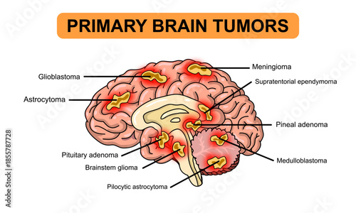 Primary brain tumors illustration. Glioblastoma, meningioma, pituitary and pineal adenoma. Cancer in cerebellum medulloblastoma and pilocytic astrocytoma. Vector illustration for medical and education
