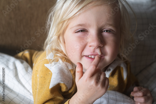 Tableau sur toile European 4 Year Old Blonde Girl Sick with Cold Resting at Home
