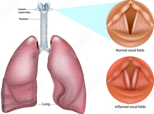 Human respiratory system with larynx, trachea, and lungs. Normal and inflamed vocal folds. Anatomical differences between healthy vocal folds and inflammation associated with laryngitis, voice disorde