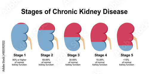 Chronic kidney disease. Stages of CKD from Healthy kidney to decreased Glomerular filtration rate and Renal failure. Vector illustration.