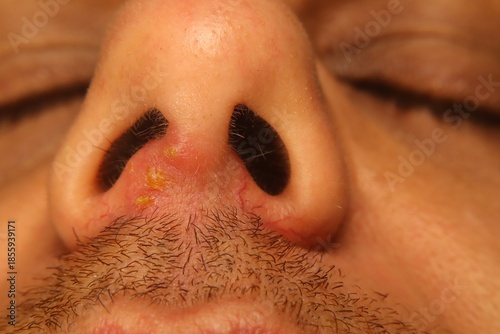 Konstfotografi Herpes Simplex Virus type 1 (HSV-1) mouth infection with cold sores triggered after severe influenza fever and psychological stress