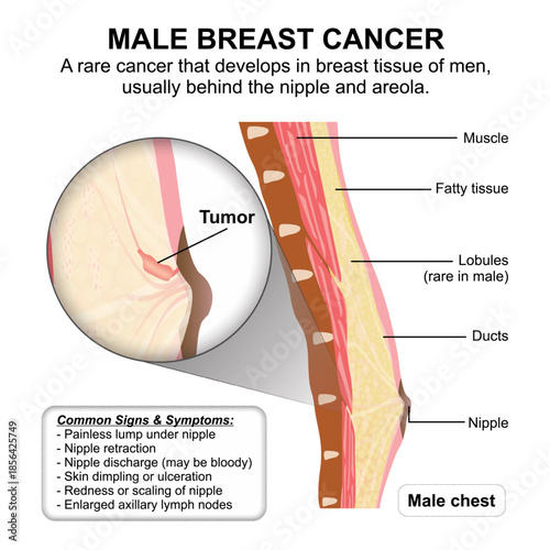 Male Breast Cancer Medical Flashcard