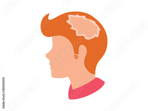 Lichen Planus Disease Clip Art
