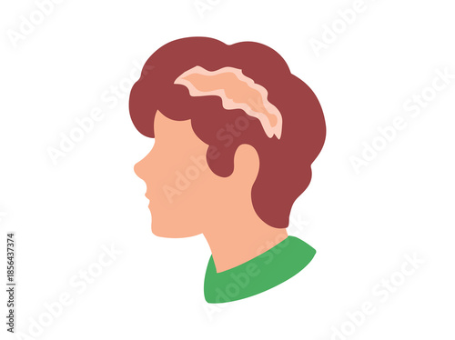 Lichen Planus Disease in Hair