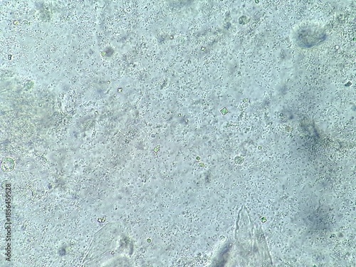 Microscopic view of urinary sediment showing calcium oxalate crystals, bacteria, epithelial cells, leukocytes, and erythrocytes. Essential for medical diagnostics and urology themes.