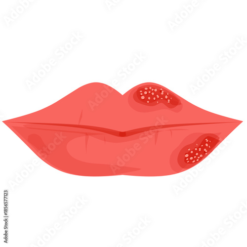 Herpes simplex virus illustration. Cold sores. Lips with blisters 