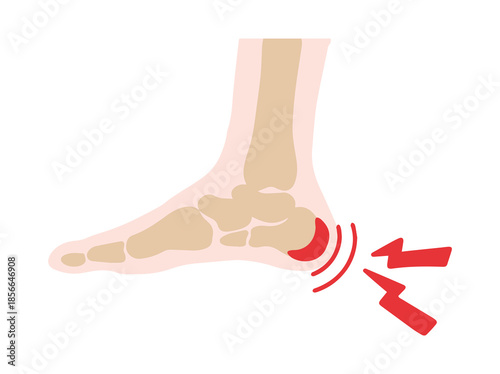 Bursitis Retrocalcaneal Disease in Heel
