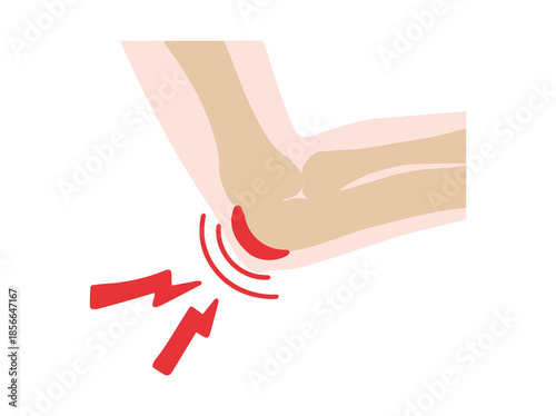Bursitis Olecranon Disease in Elbow
