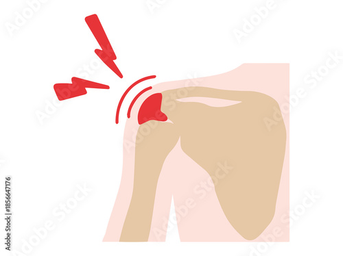 Bursitis Subacromial Disease in Shoulder
