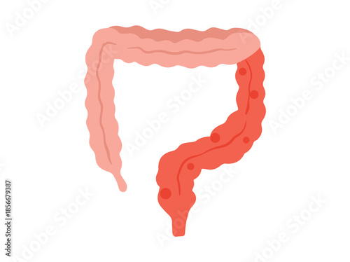 Hand Drawn Colitis Disease in Intestines
