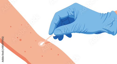 Dermatologist or scientist in a blue glove using a cotton swab to take a sample from a patient's skin rash.