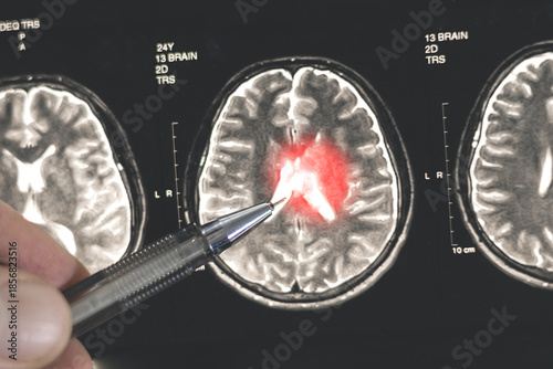 A doctor examines an X-ray of a human brain. Treatment head diseases. Close up.