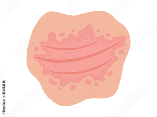Inverse Psoriasis Disease in Skin Illustration
