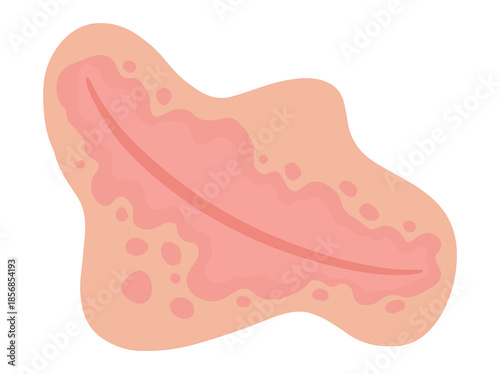Inverse Psoriasis Disease in Skin