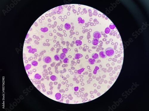 Leukemia blood smear moderate Immature cell.