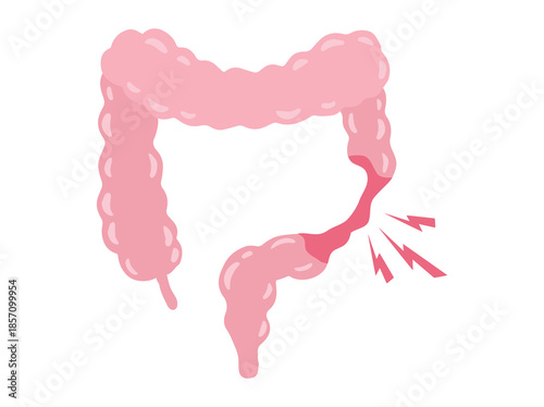Irritable Bowel Syndrome IBS in Intestines Illustration
