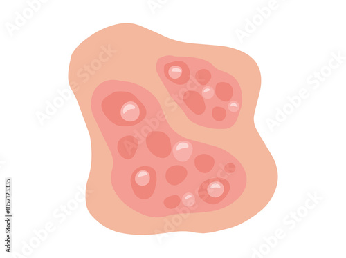Pustular Psoriasis Disease in Skin
