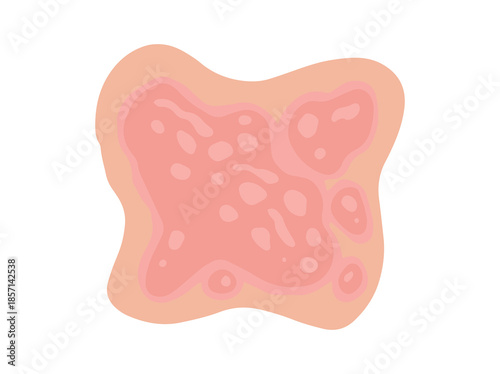 Erythrodermic Psoriasis Disease in Skin
