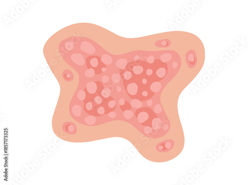 Hand Drawn Plaque Psoriasis Disease
