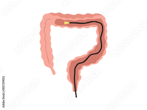 Sigmoidoscopy or Colonoscopy in Intestinal Colon
