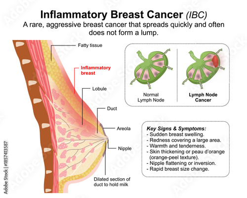 Inflammatory Breast Cancer (IBC)