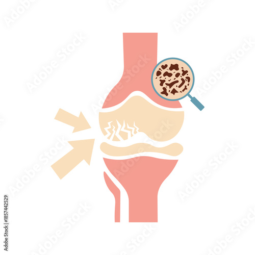 Osteoporosis Illustration