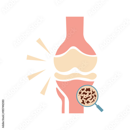 Osteoporosis Illustration