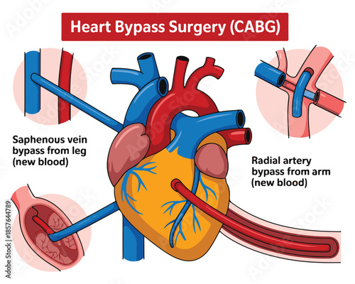 Diagram of Heart Bypass Surgery ( CABG) with Saphenous Vein and Radial Artery Grafts cabg coronary artery bypass grafting