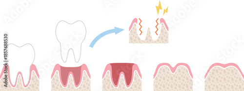 抜歯後の回復過程とドライソケットの図解　文字なし